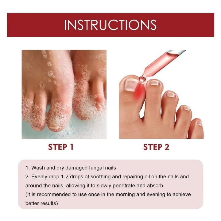 ToePerfect™ Anti paronychia verlichtingsolie | 1 + 1 Gratis